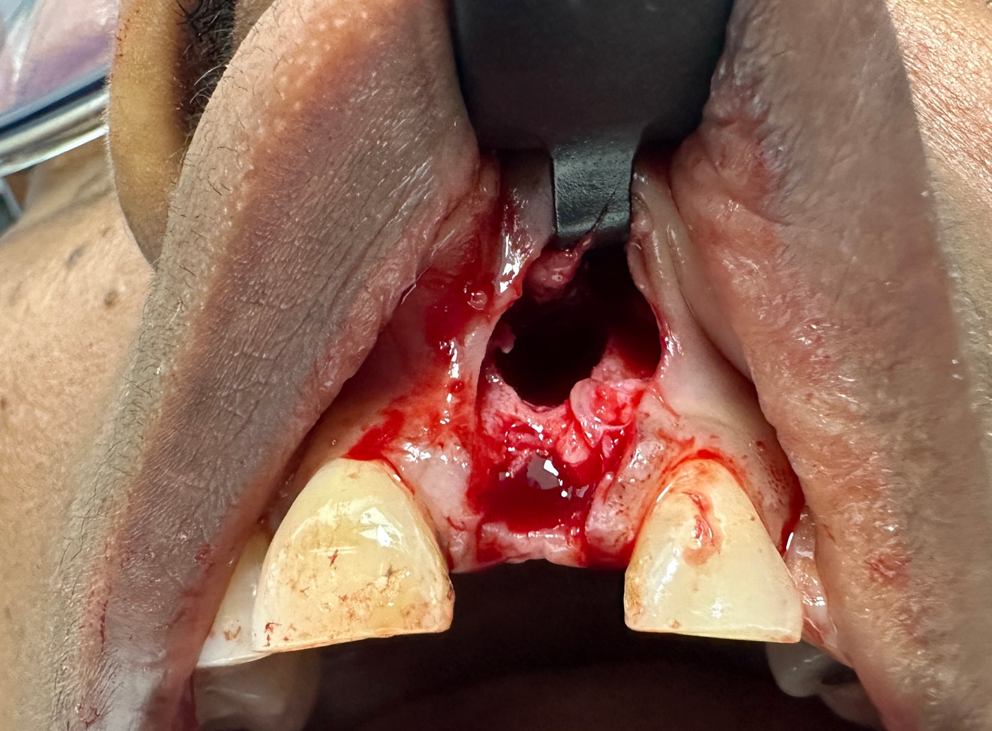 Implant Success Retractors